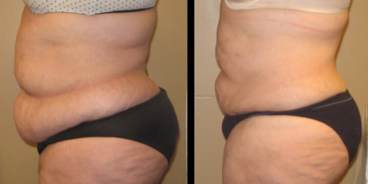 Tummy Tuck Before and After Pictures Case 17